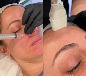 microneedling