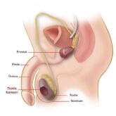 Ce este cancerul testicular, simptomele și tratamentul acestuia