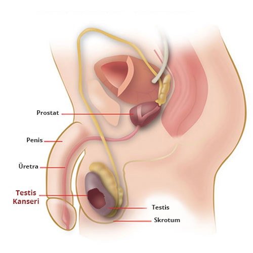 Ce este cancerul testicular simptomele si tratamentul acestuia