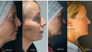 E4 Body Fixer Dr. Nina Bal dezvăluie rezultatele incredibilului ei lifting facial nechirurgical