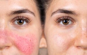 bbllasertreatmentrosacea