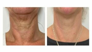 Pielea lăsată Acest lifting facial nechirurgical vă poate lua ani de zile de pe fața MÂNĂ (2)